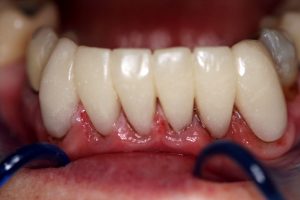 lower_anterior_replacement_crowns_after