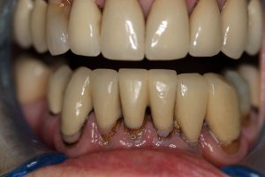 lower_anterior_replacement_crowns_before